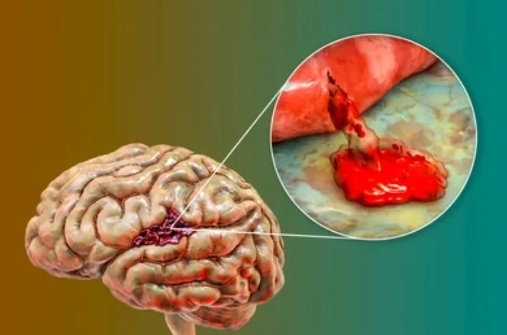 Brain Hemorrhage