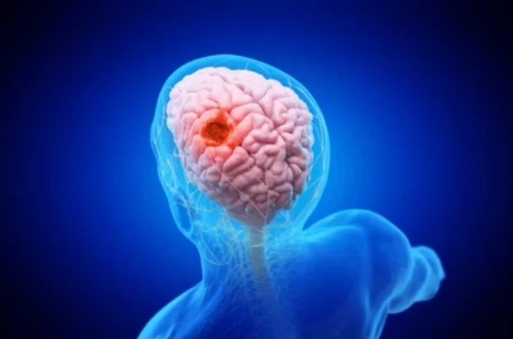 Brain Tumors