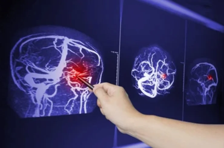 Traumatic Brain Injury